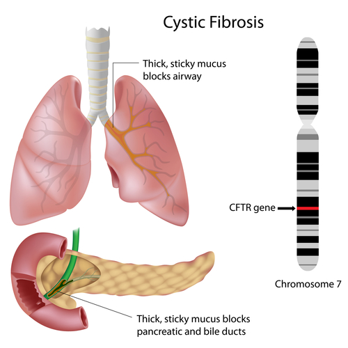cystic fibrosis and insulin
