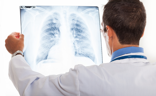 Cystic Fibrosis and Lung Transplant | CF Lung Transplant Life Expectancy