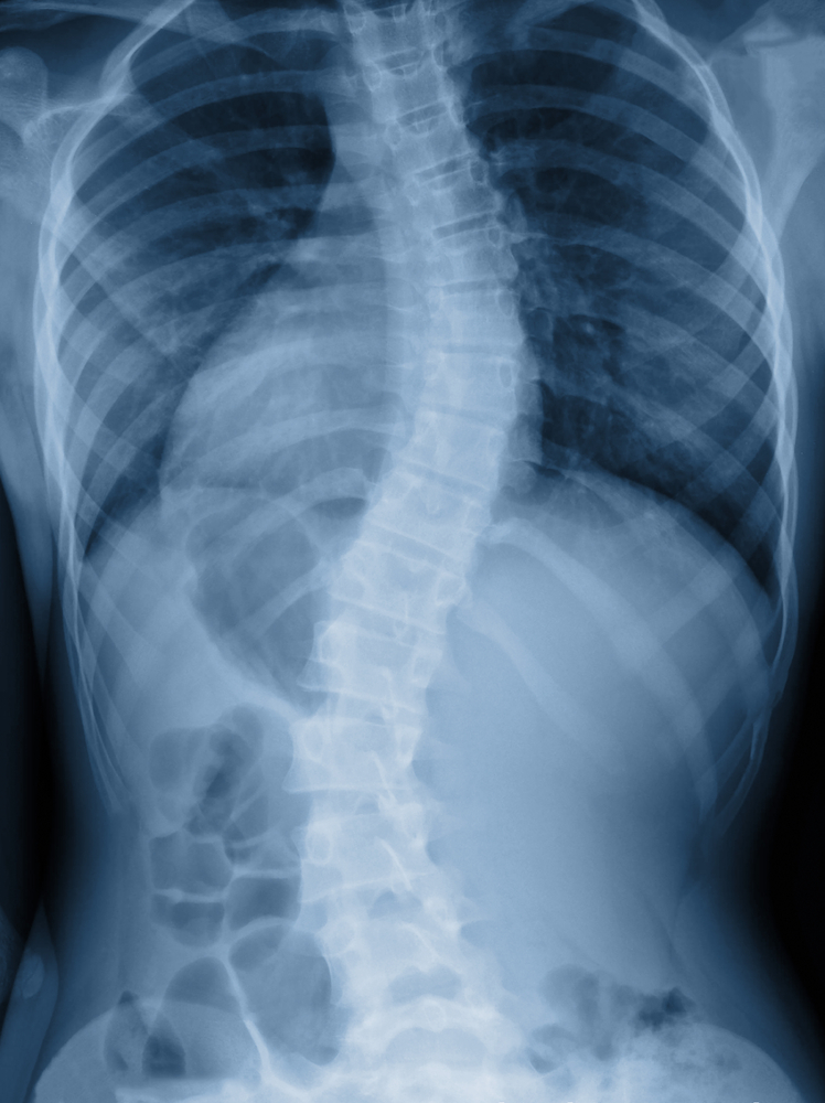 spine deformities in cystic fibrosis
