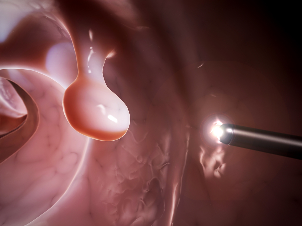 Colonoscopies for CF patients