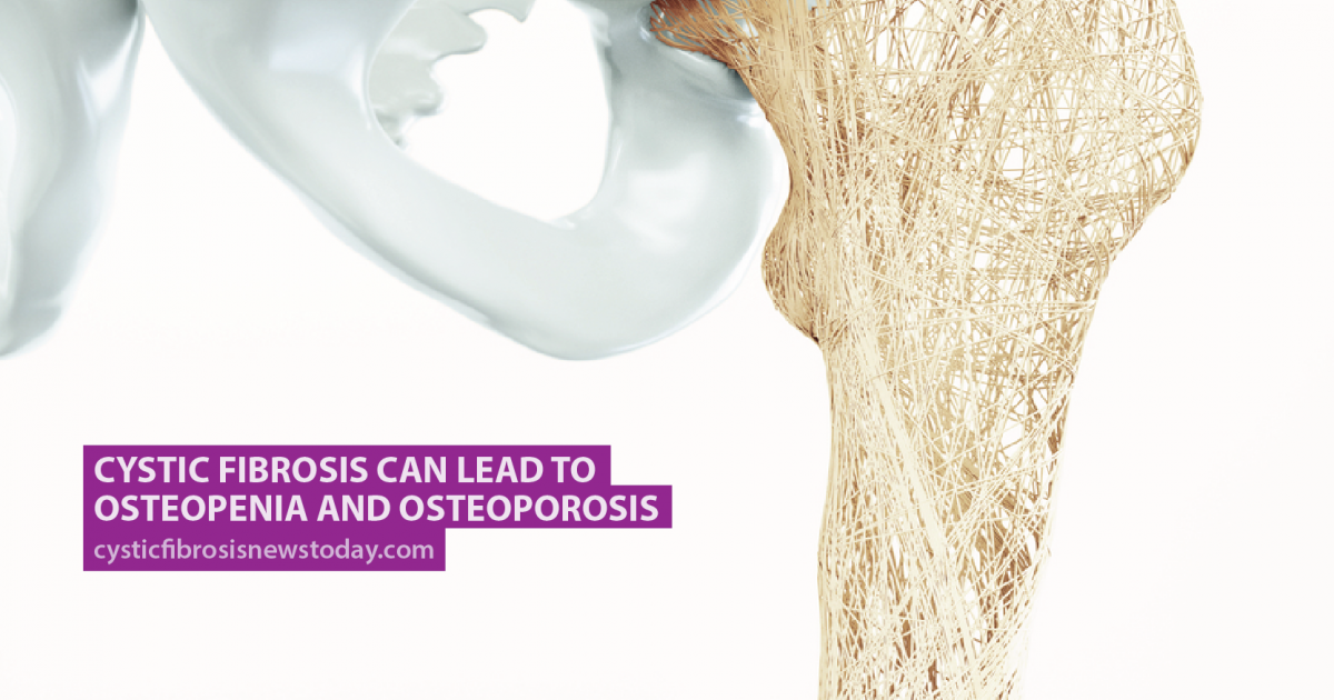 Cystic Fibrosis Can Lead to Osteopenia and Osteoporosis - Cystic