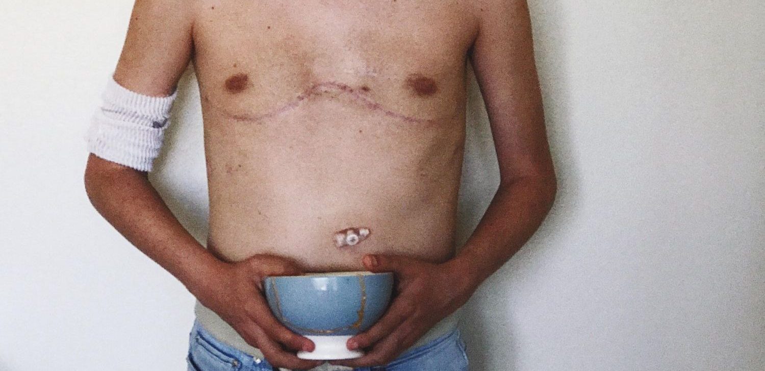 lung transplant scar