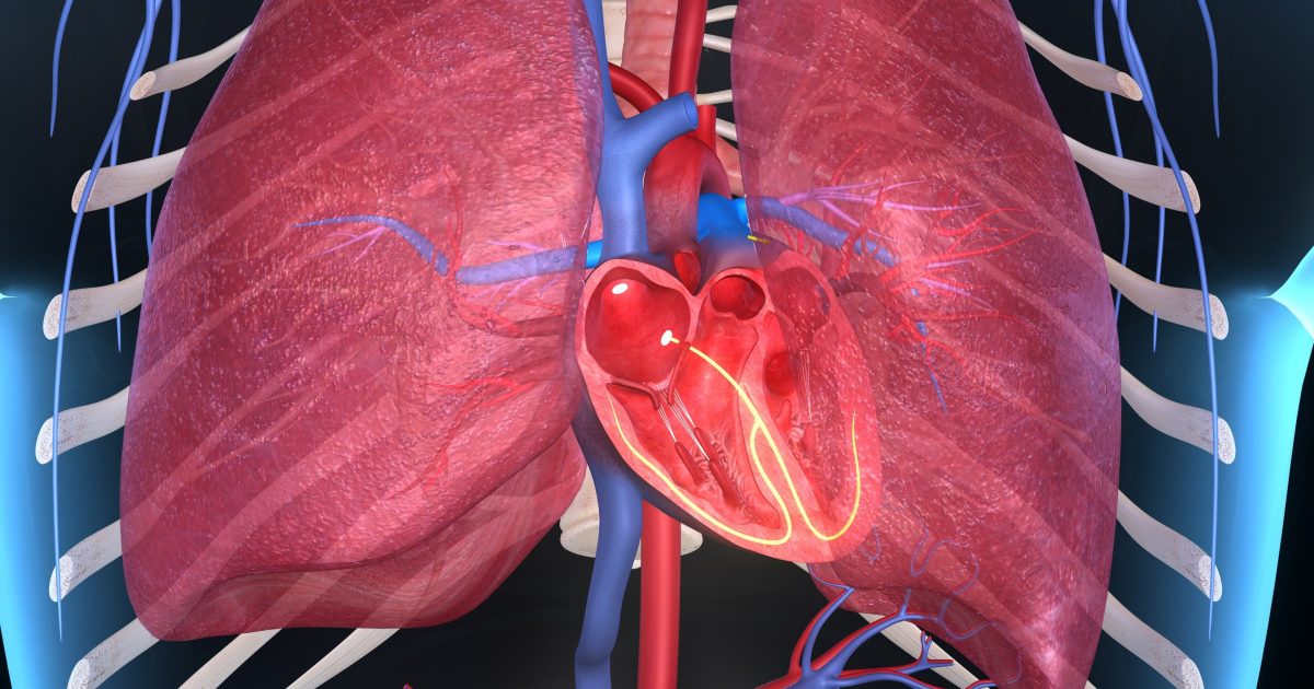 Enlarged Pulmonary Artery Predicts PH and Lower Survival in Severe CF