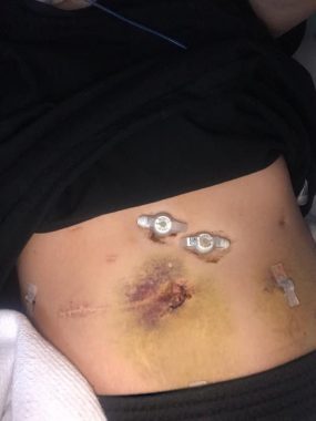 gastric pacemaker / Cystic Fibrosis News Today / Photo of Bailey's abdomen, revealing scars, tubes, and bruising.