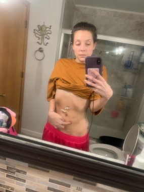 gastric pacemaker / Cystic Fibrosis News Today / Bailey takes a selfie in her bathroom mirror while pointing to her abdomen.