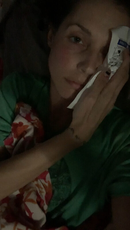 A woman takes a close-up selfie in a dark room. She appears to be lying down and is holding ice packs against one side of her face.