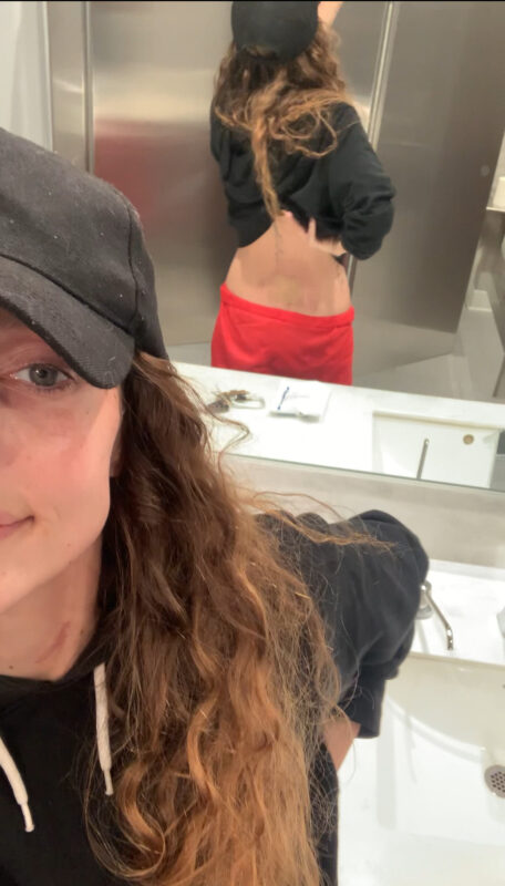 A woman stands with her back to a mirror and takes a selfie, so that we can see her lower back in the reflection. She's wearing a black baseball cap, black sweatshirt, and red pants, and her lower back looks red and swollen from steroid injections.